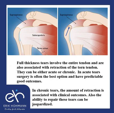 supraspinatus tear tests|complete rupture of supraspinatus tendon.